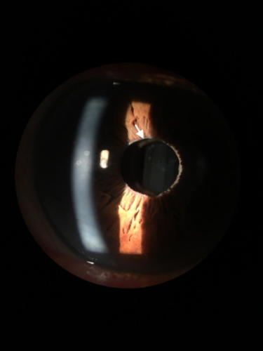 PEX syndrom